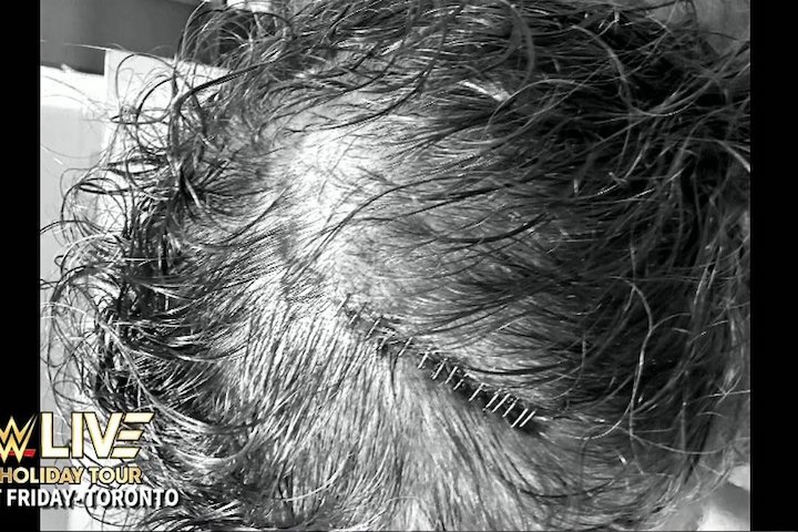 WWE Provides Injury Update On Sami Zayn; 15 Staples Required...