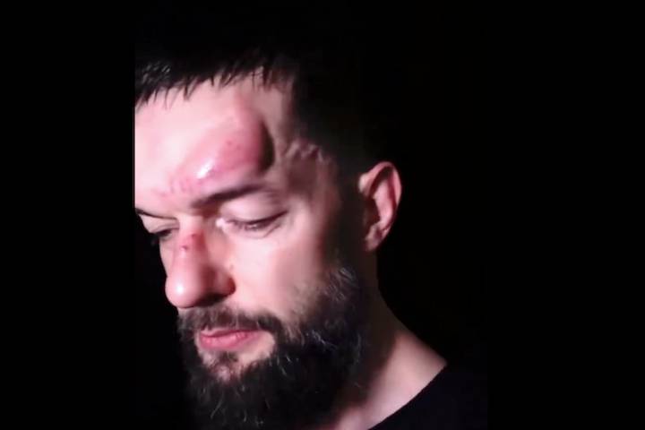 WWE's Finn Balor Shows Off Facial Injury Ahead Of WrestleMania 40