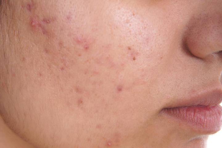 ACNE-INTRODUCTION, CAUSES, SYMPTOMS AND AYURVEDIC TREATMENT ...