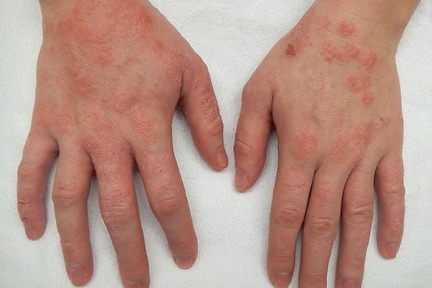 ECZEMA-INTRODUCTION,SIGN&SYMPTOMS,TREATMENT AND HOME REMEDIE...