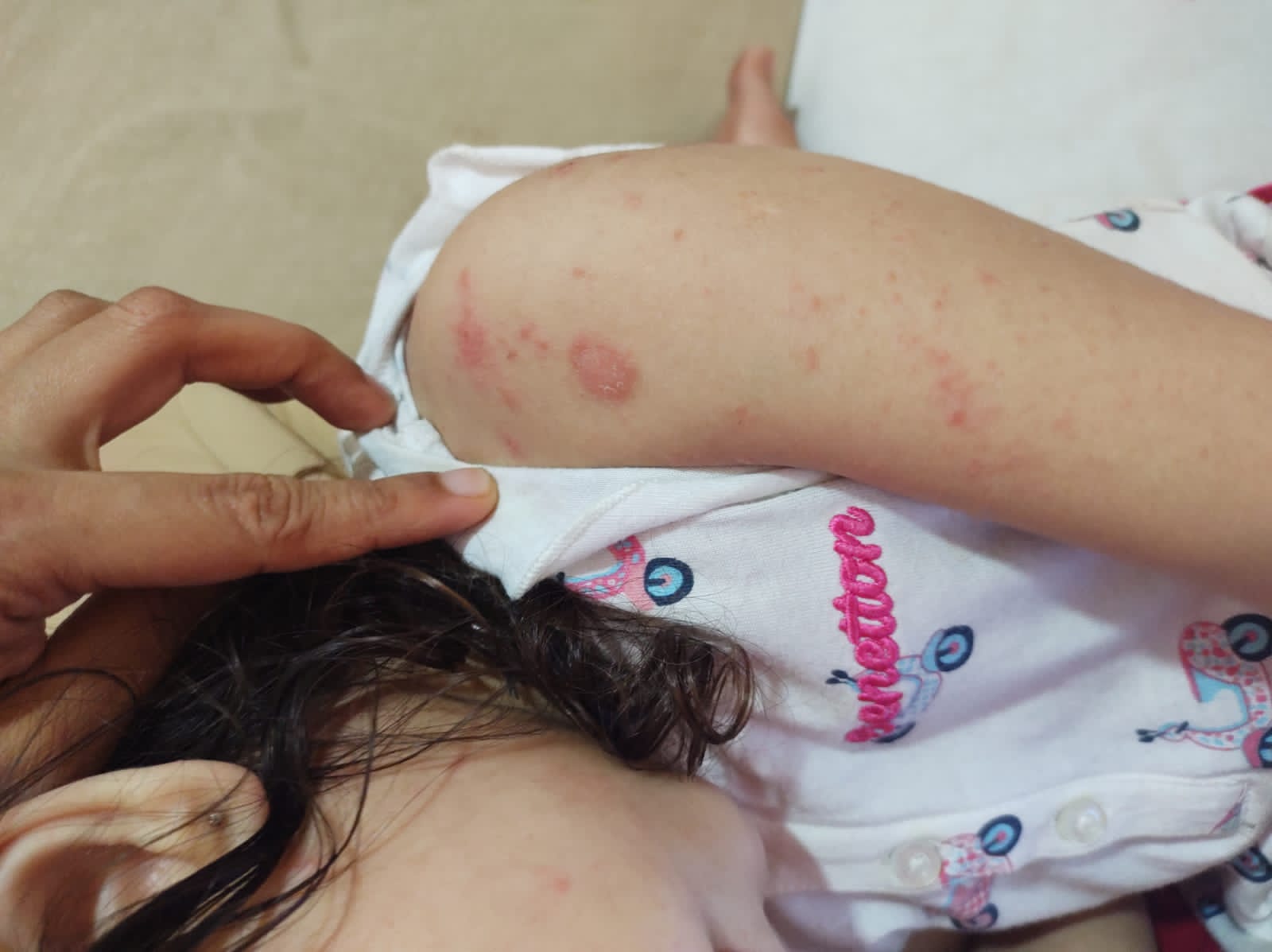 IMPETIGO
ACCORDING TO ALLOPATHY AND AYURVEDA(INTRODUCTION,C...