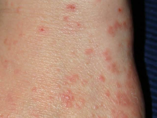 Scabies
Introduction, causes, symptoms and treatment
