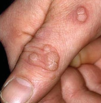 WARTS-CAUSES, SYMPTOMS AND MANAGMENT ACCORDING TO AYURVEDA A...