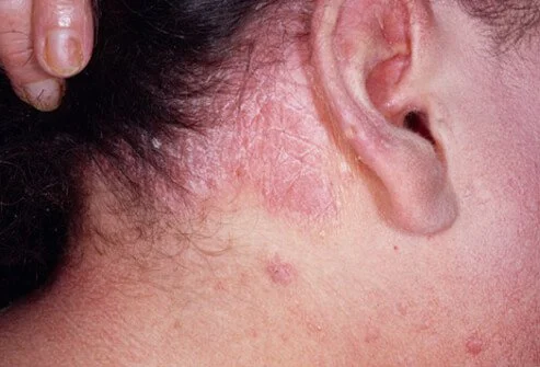 PSORIASIS(KITIBHA)- INTRODUCTION,CAUSES, SYMPTOMS AND MANAGM...