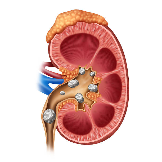 What is Renal stone(Ashmari)| Details Below