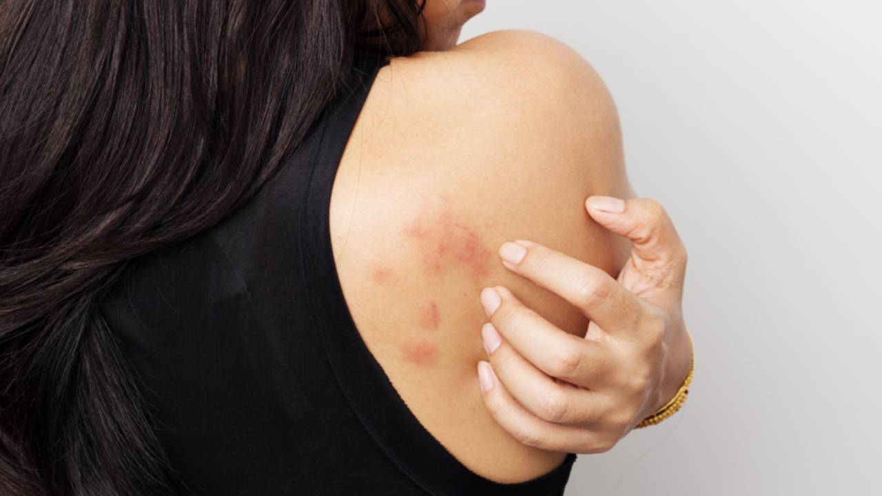 Urticaria (Sheetapitta)-causes, symptoms and treatment